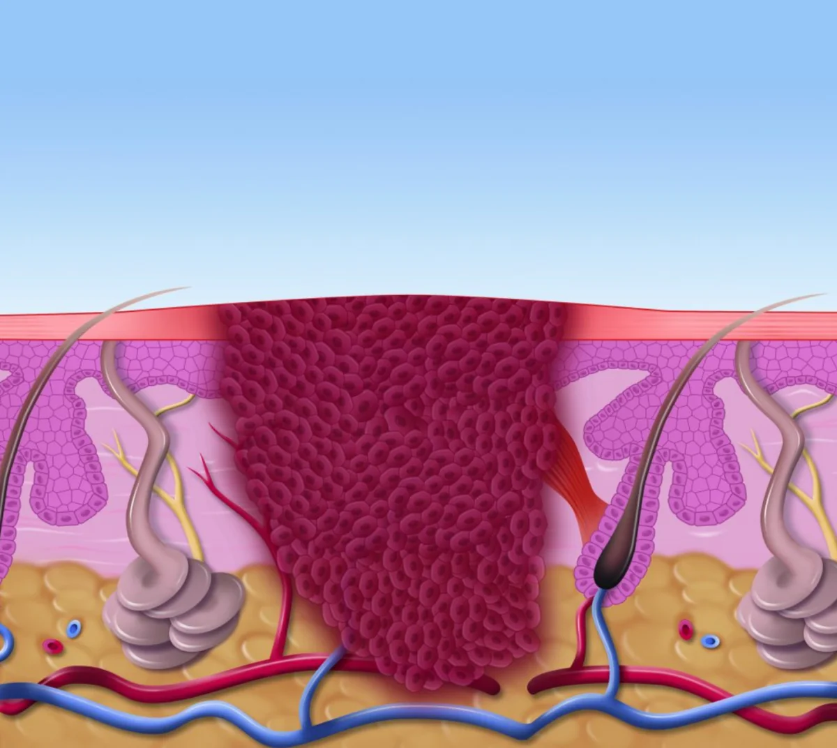 Illustration of a verruca within the layers of the skin