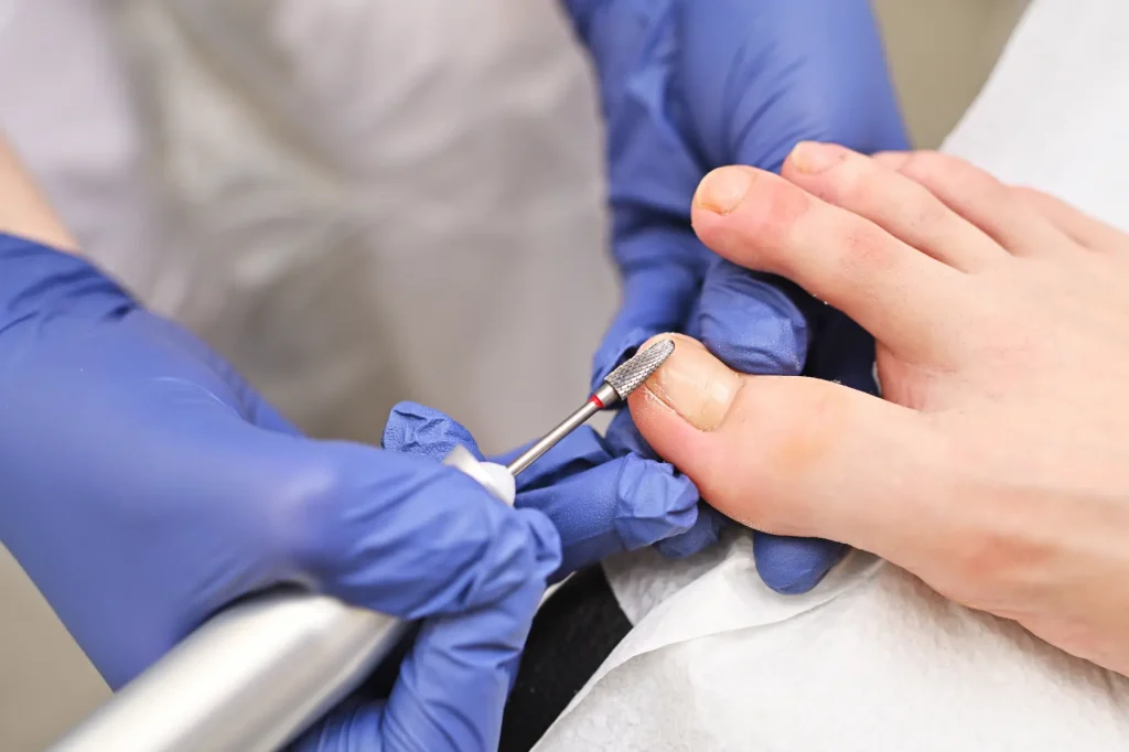 Ingrown Toenail