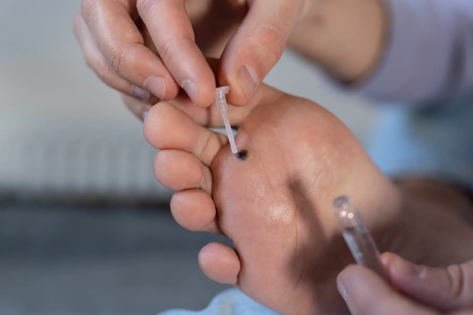 Verruca Treatment in Lewisham - Swift and Needling Options