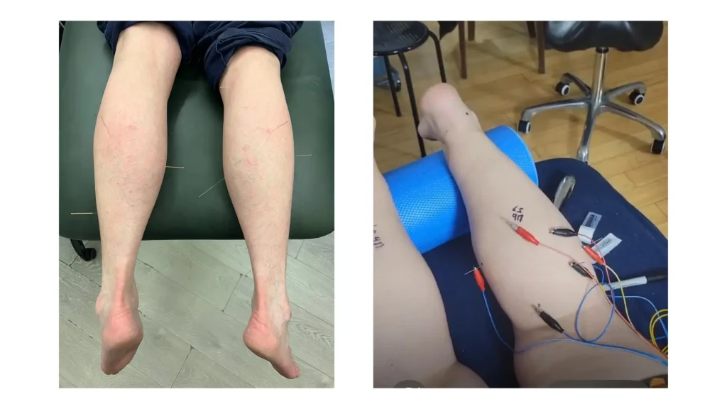 Electroacupuncture & Dry Needling London